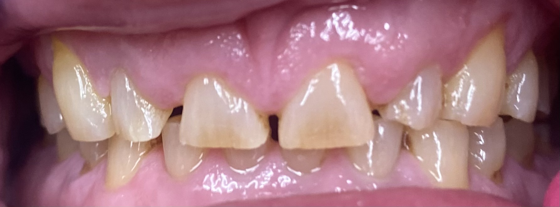 Before full mouth restoration